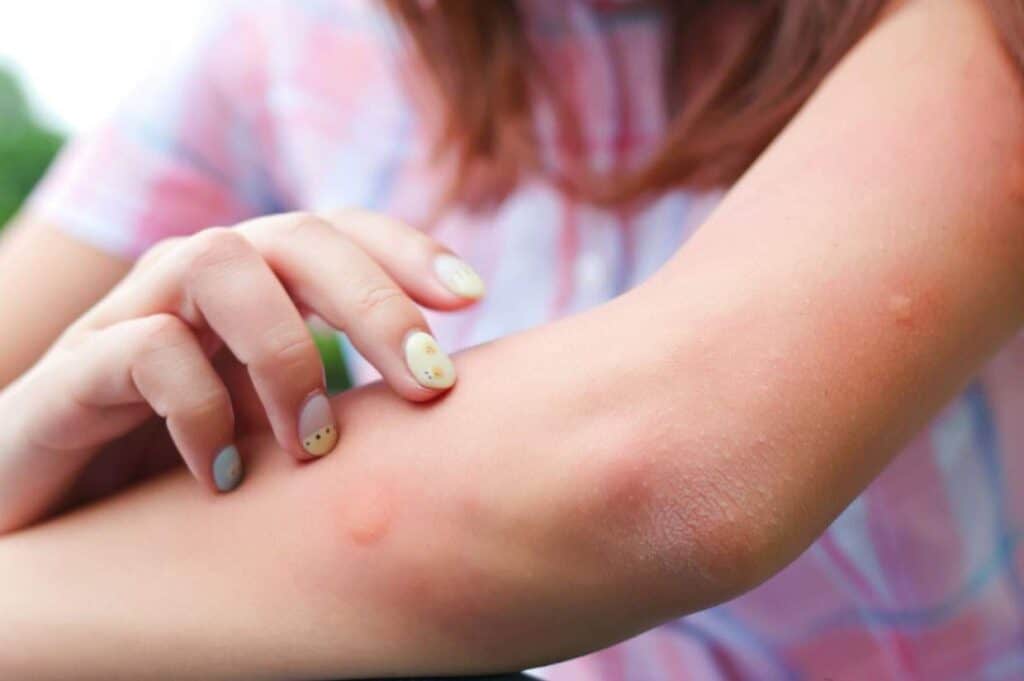 A close-up of a person scratching their forearm, showing red bumps and irritation from bug bites. The person has manicured fingernails with colorful nail polish. Perhaps some essential oils for bug bites might offer relief to the irritated skin.