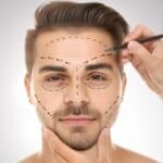 A person with facial hair is shown with dotted lines drawn on their face, while another hand uses a pencil to mark areas, suggesting preparation for cosmetic procedures.